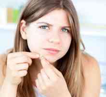 Come prevenire l`acne