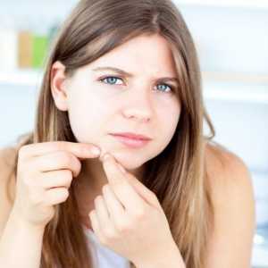 Come prevenire l`acne